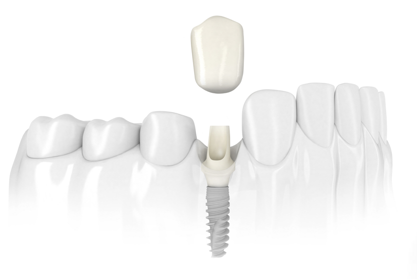 dental-implant-mage-1
