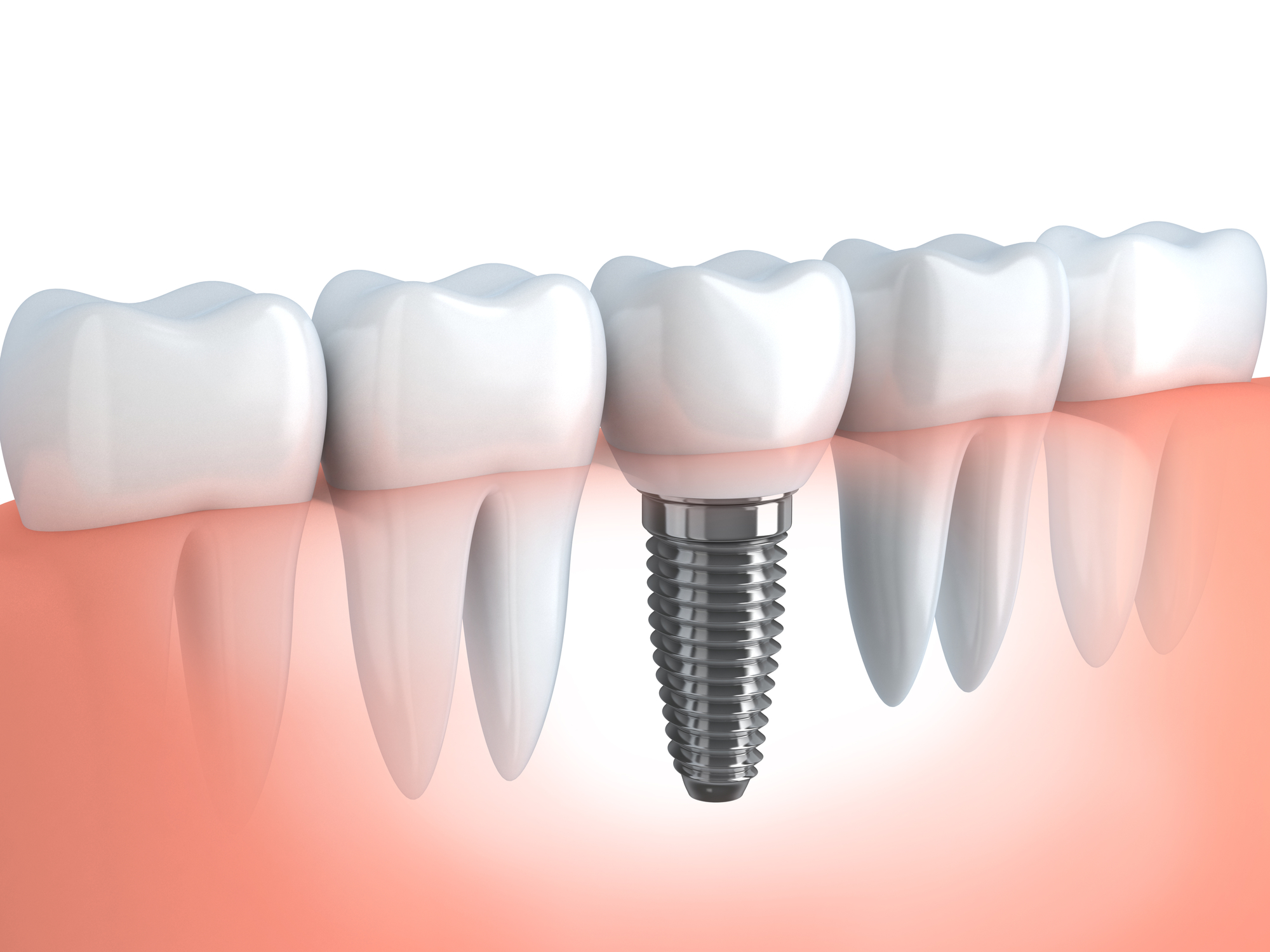 Dental implant image