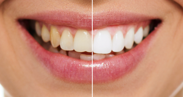 teeth-whitening-before-after image