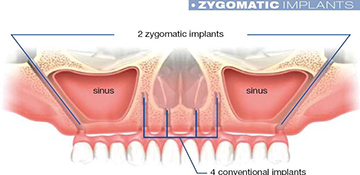 zygoma-implants image
